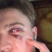 29-Year-Old Trans Man Gets Brutally Beaten Up In Switzerland, Claims It’s A Hate Crime