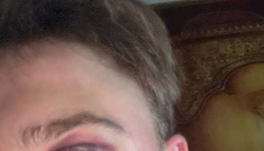 29-Year-Old Trans Man Gets Brutally Beaten Up In Switzerland, Claims It’s A Hate Crime