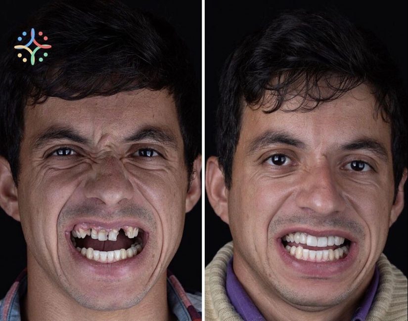 30 fotos antes y después de que la gente recuperara su sonrisa