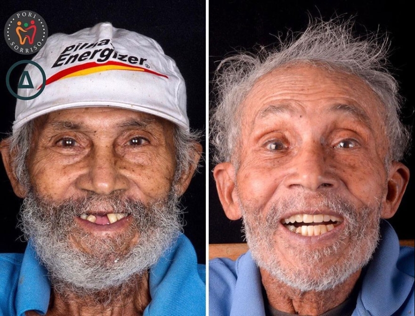 30 photos before and after people got their smile back