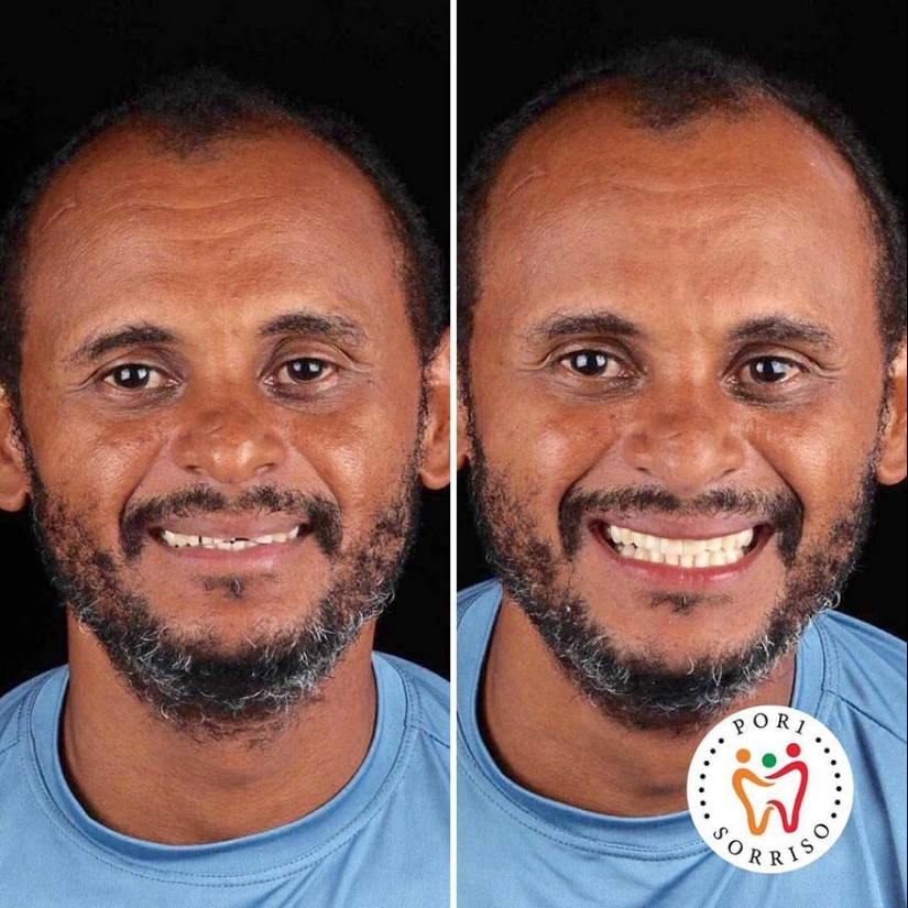 30 photos before and after people got their smile back