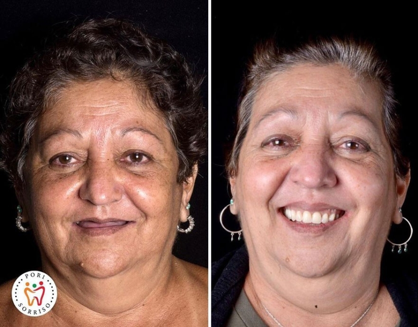 30 photos before and after people got their smile back