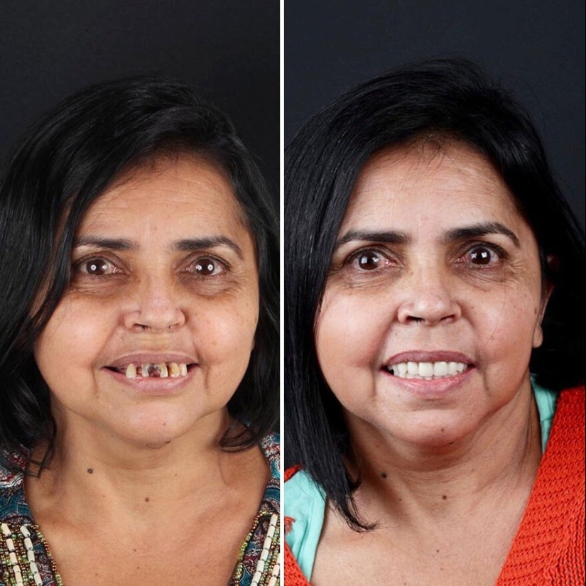 30 photos before and after people got their smile back