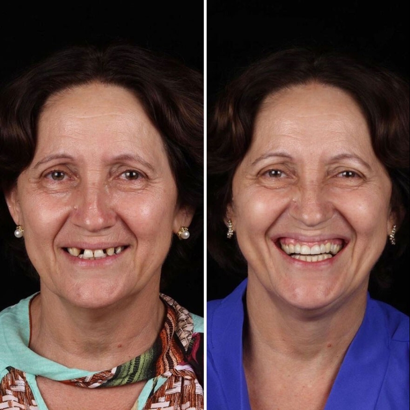 30 photos before and after people got their smile back