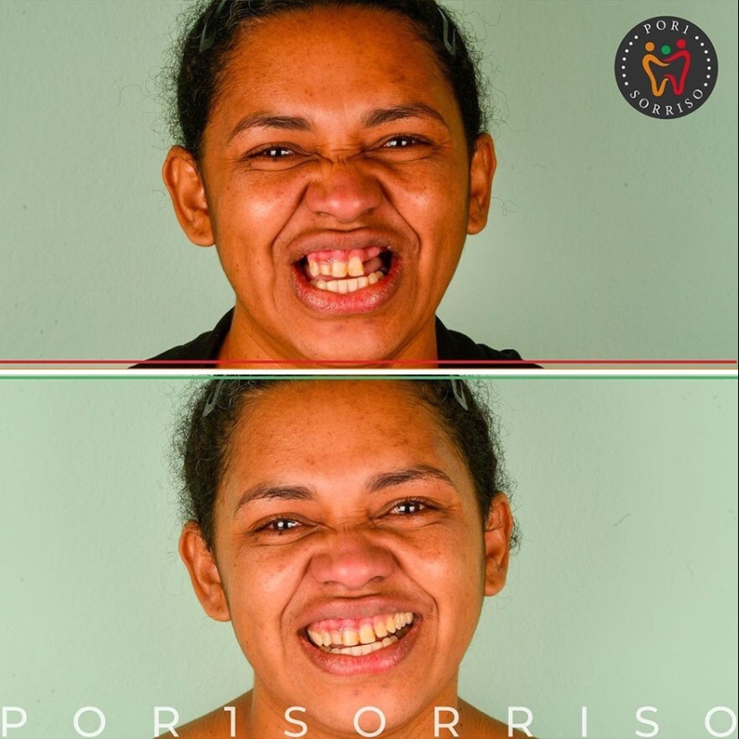 30 photos before and after people got their smile back