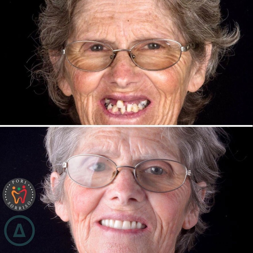 30 photos before and after people got their smile back