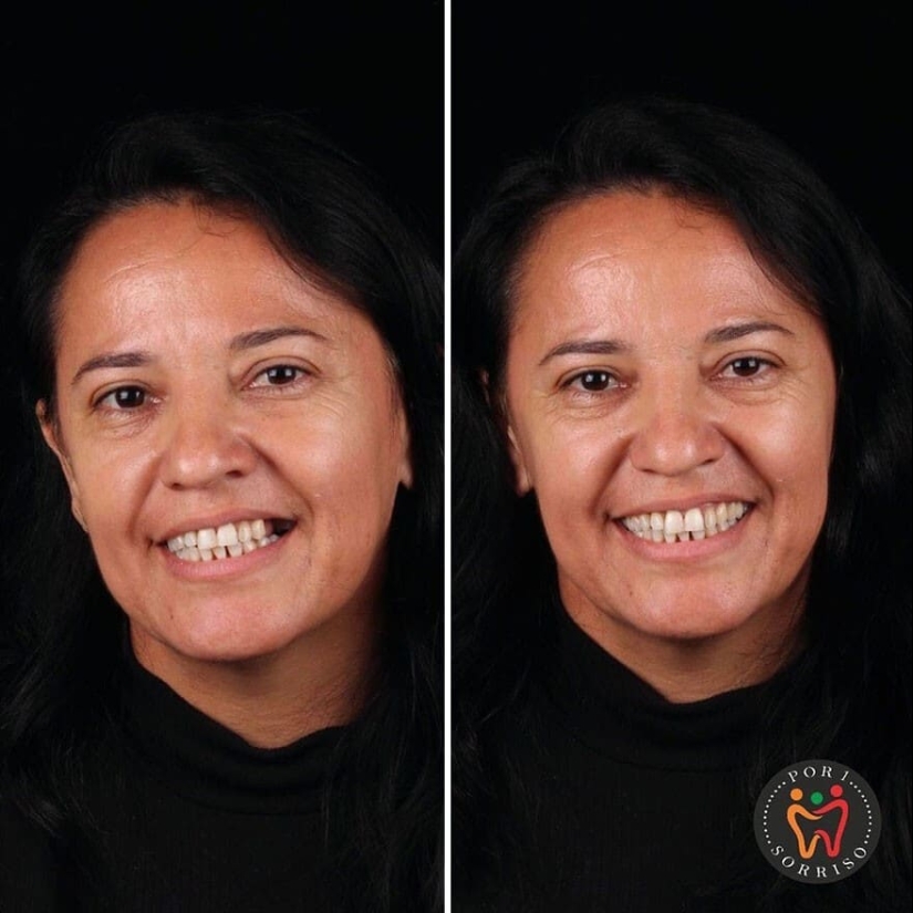 30 photos before and after people got their smile back