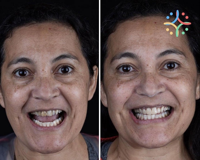 30 photos before and after people got their smile back