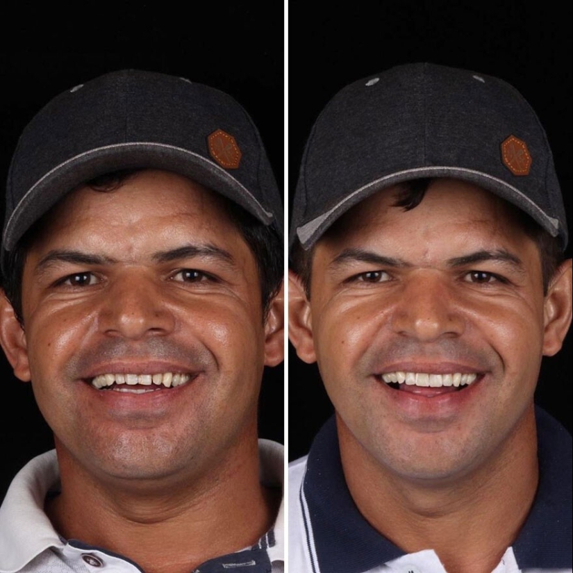 30 photos before and after people got their smile back