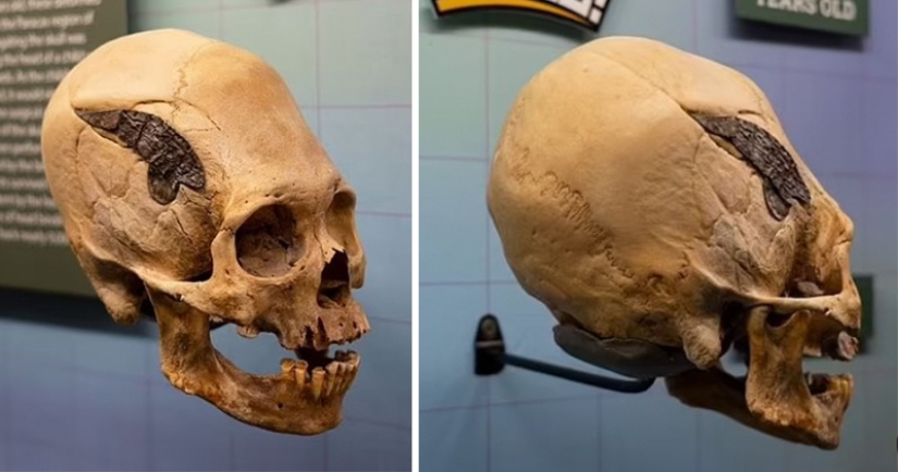 A human skull bonded with metal 2000 years ago amazed scientists