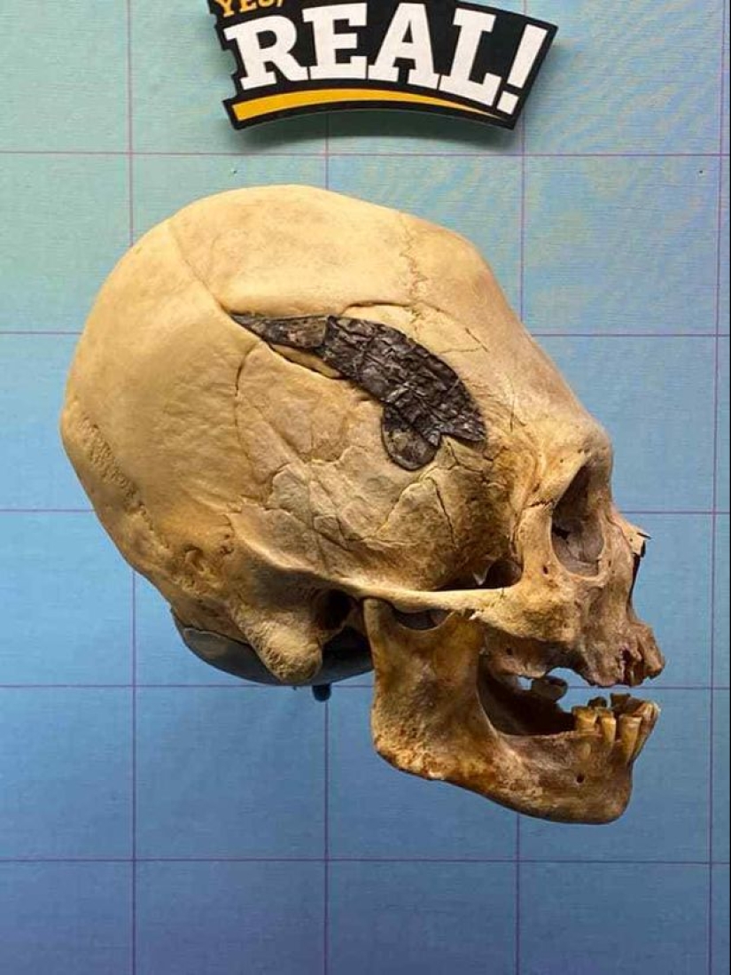 A human skull bonded with metal 2000 years ago amazed scientists