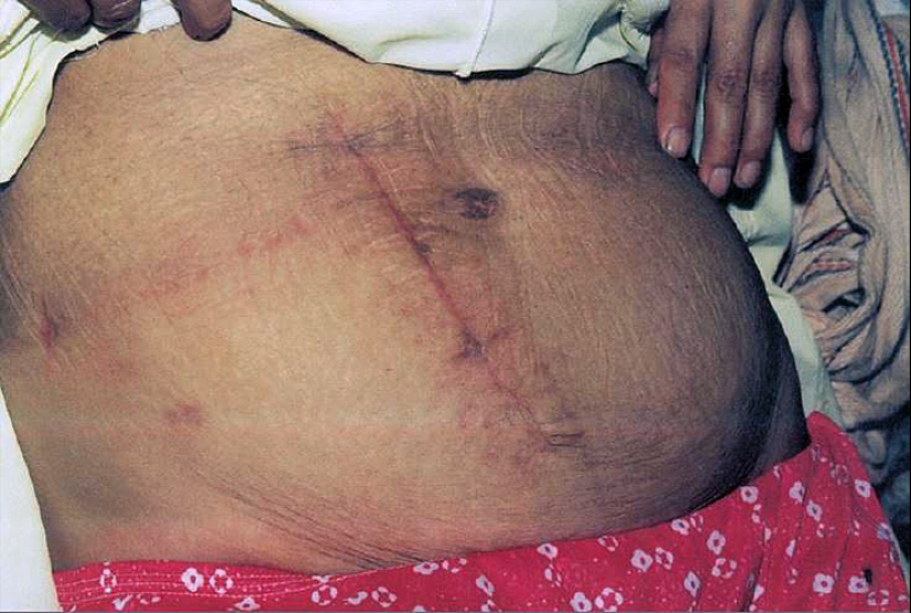 A Mexican woman became a sensation by making herself a caesarean section with a kitchen knife