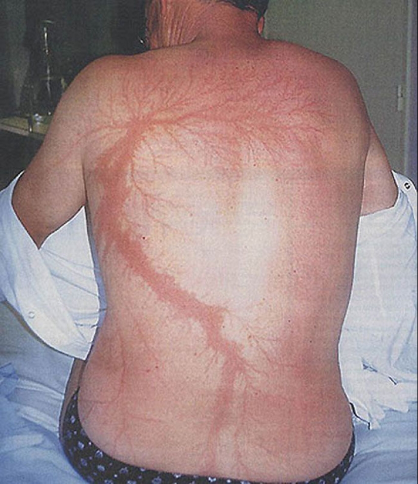 After discharge: what happens to a man who was struck by lightning