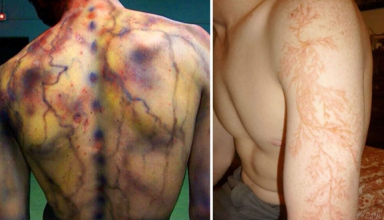 After discharge: what happens to a man who was struck by lightning