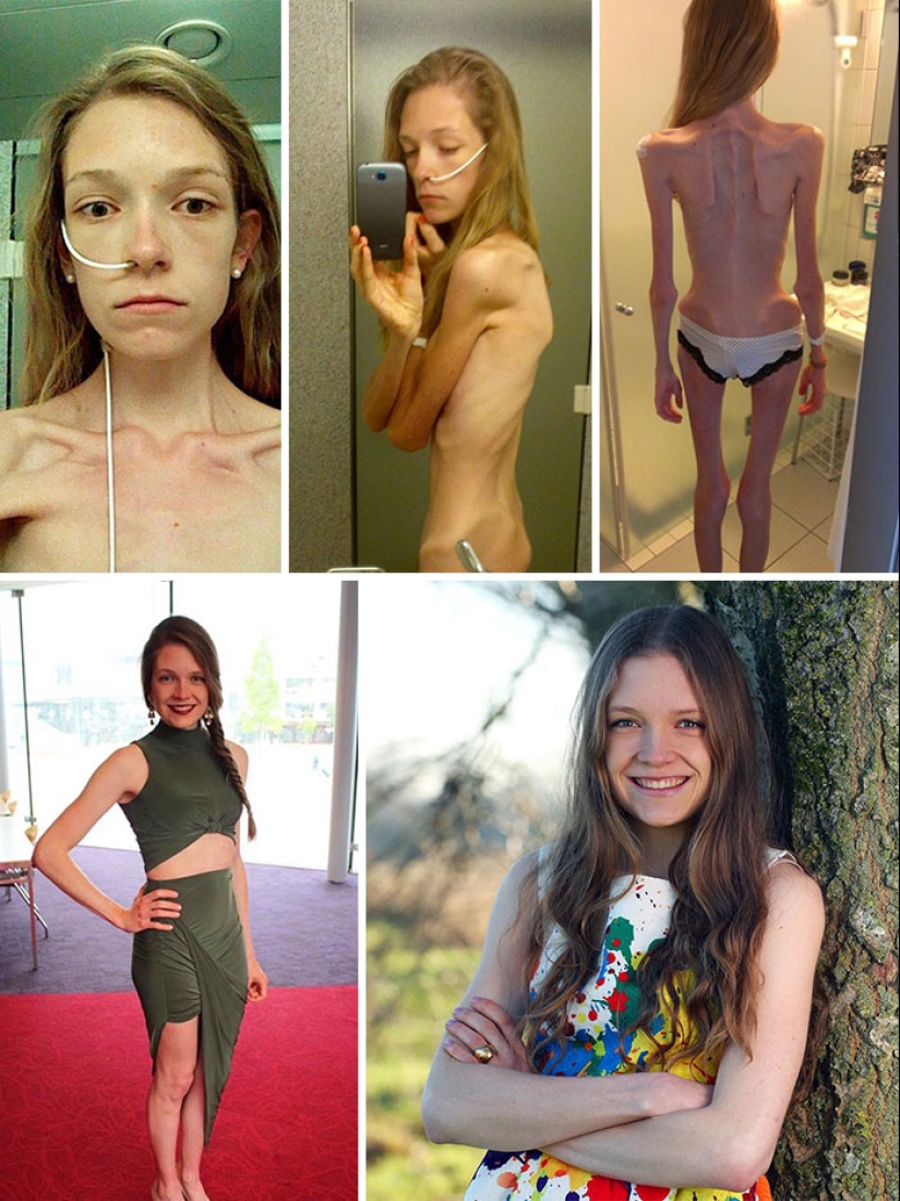 Antes y después: 20 ejemplos de personas que lograron superar la anorexia