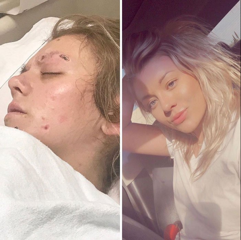 Before and after: 20 photos of people who decided to stop using drugs