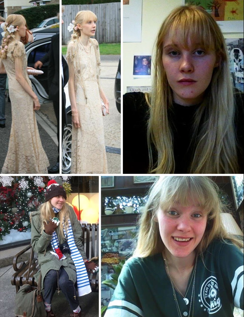 Before and after: 20 examples of people who managed to overcome anorexia