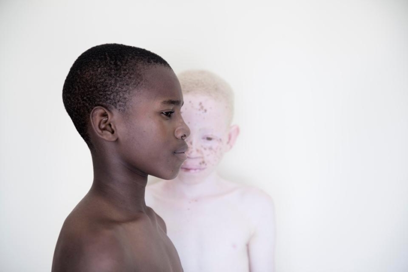 Blancura mortal: Increíbles retratos de albinos de Tanzania