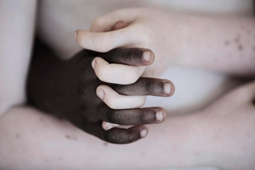 Blancura mortal: Increíbles retratos de albinos de Tanzania