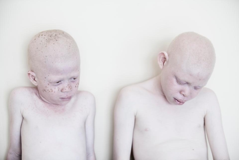 Blancura mortal: Increíbles retratos de albinos de Tanzania