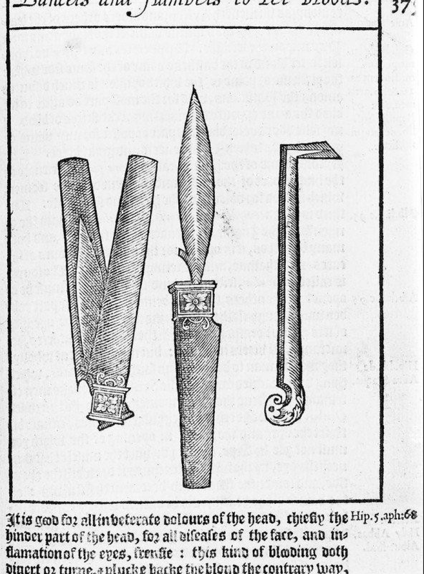 "Blood opening": what is the essence of bloodletting treatment, which often had the opposite effect