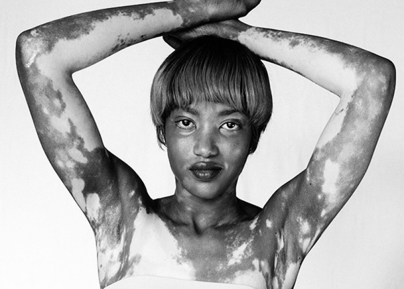 Discover the beauty of vitiligo