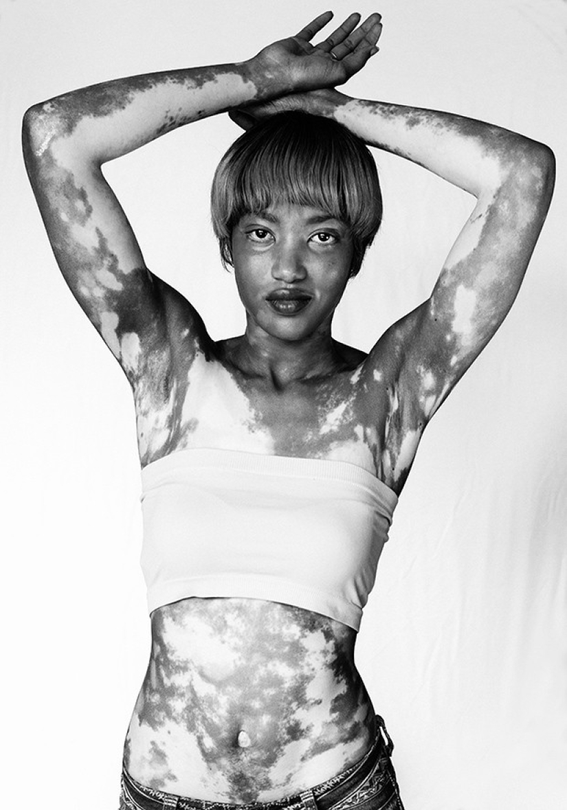 Discover the beauty of vitiligo