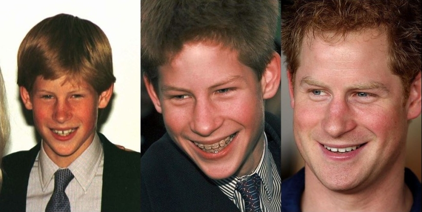 Estas celebridades le mostrarán cómo los frenillos pueden cambiar drásticamente su sonrisa.
