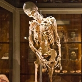 Fibrodysplasia is a terrible disease that turns a person into a bone idol