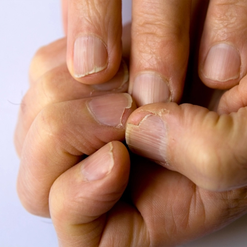 From arthritis to melanoma: 10 signs of serious diseases that can be identified by nails