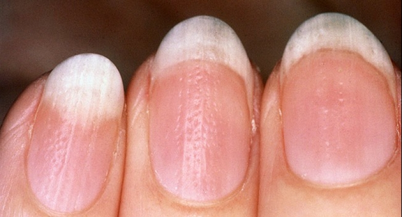 From arthritis to melanoma: 10 signs of serious diseases that can be identified by nails