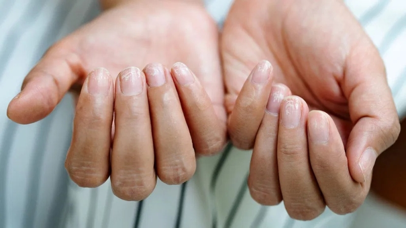 From arthritis to melanoma: 10 signs of serious diseases that can be identified by nails