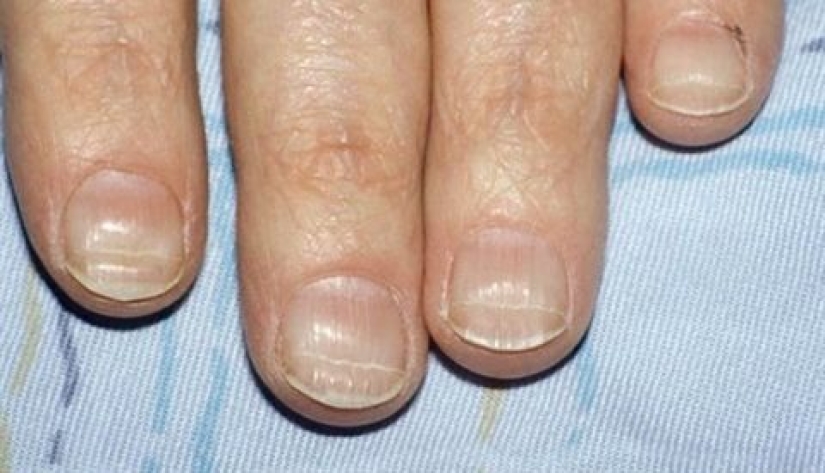 From arthritis to melanoma: 10 signs of serious diseases that can be identified by nails