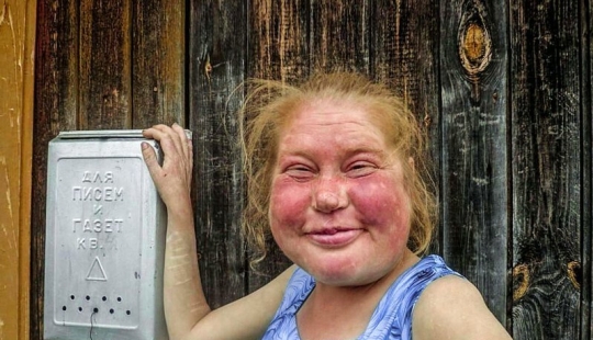 Gastronomy tan, or How to recognize an alcoholic in appearance