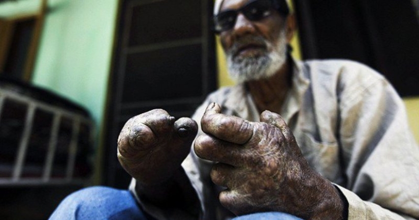 History of leprosy: why humanity has conquered, but not defeated "lazy death"