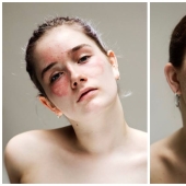 In your skin: a powerful photo project "Epidermis" by Sophie Harris-Taylor