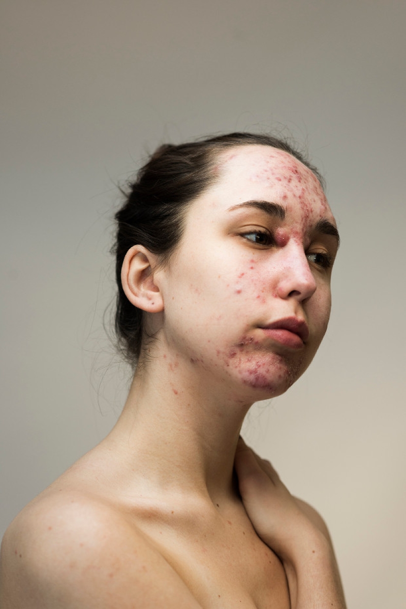 In your skin: a powerful photo project "Epidermis" by Sophie Harris-Taylor