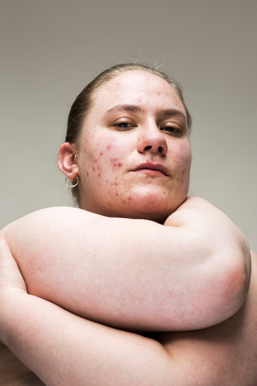 In your skin: a powerful photo project "Epidermis" by Sophie Harris-Taylor