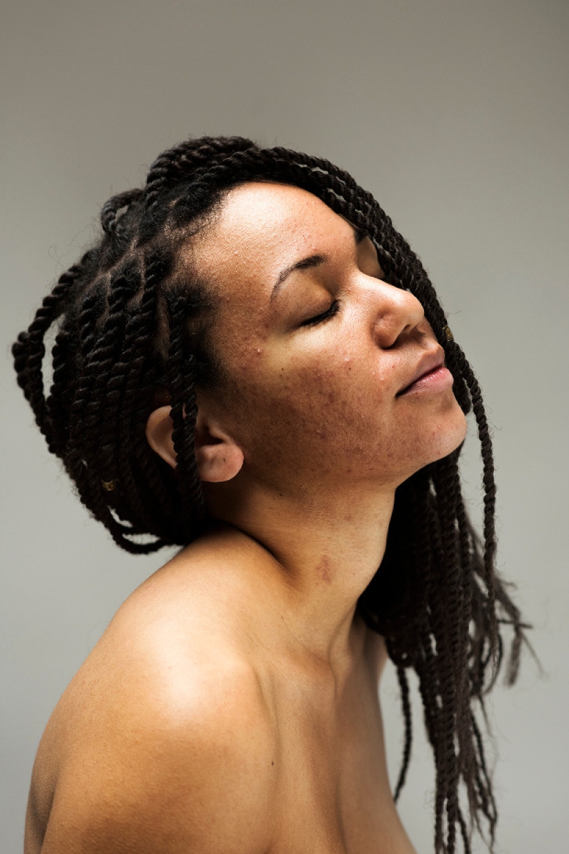 In your skin: a powerful photo project "Epidermis" by Sophie Harris-Taylor