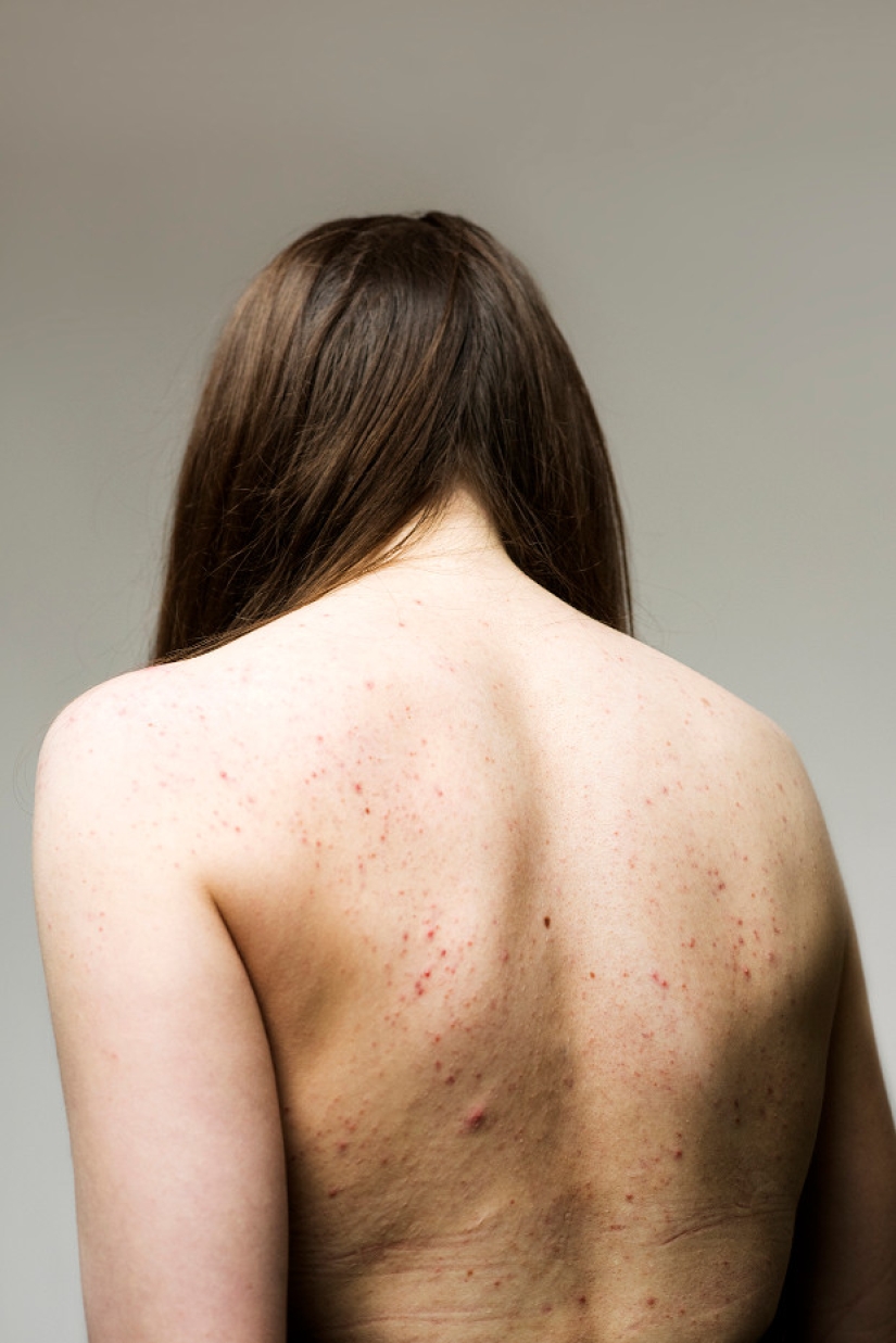 In your skin: a powerful photo project "Epidermis" by Sophie Harris-Taylor