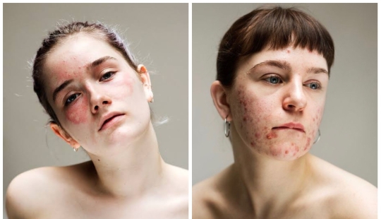 In your skin: a powerful photo project "Epidermis" by Sophie Harris-Taylor