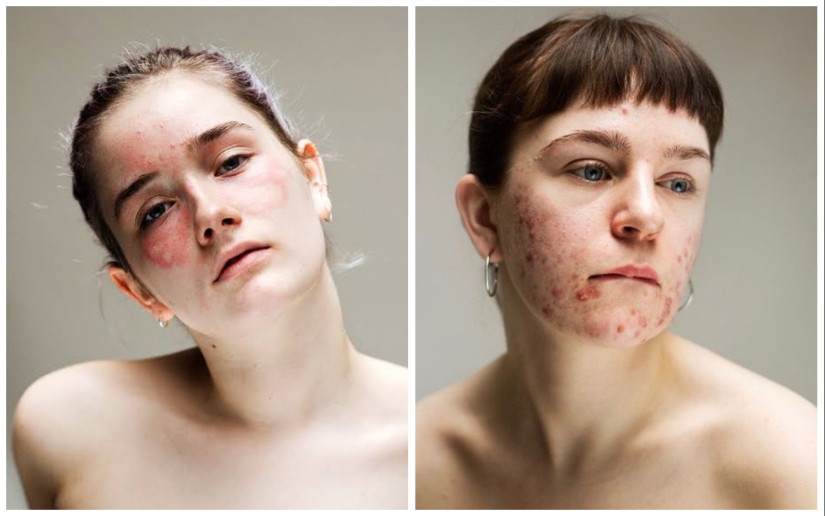 In your skin: un potente proyecto fotográfico "Epidermis" de Sophie Harris-Taylor