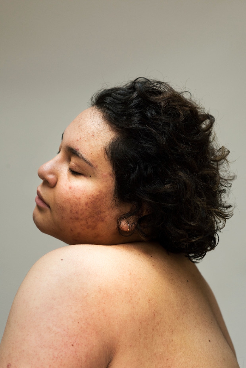 In your skin: un potente proyecto fotográfico "Epidermis" de Sophie Harris-Taylor