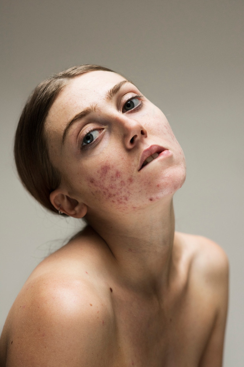 In your skin: un potente proyecto fotográfico "Epidermis" de Sophie Harris-Taylor