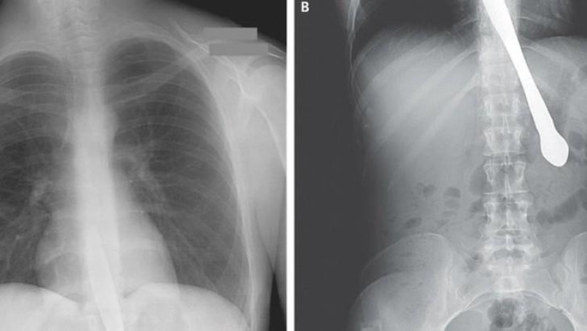 Los objetos más increíbles que se han encontrado en el cuerpo humano