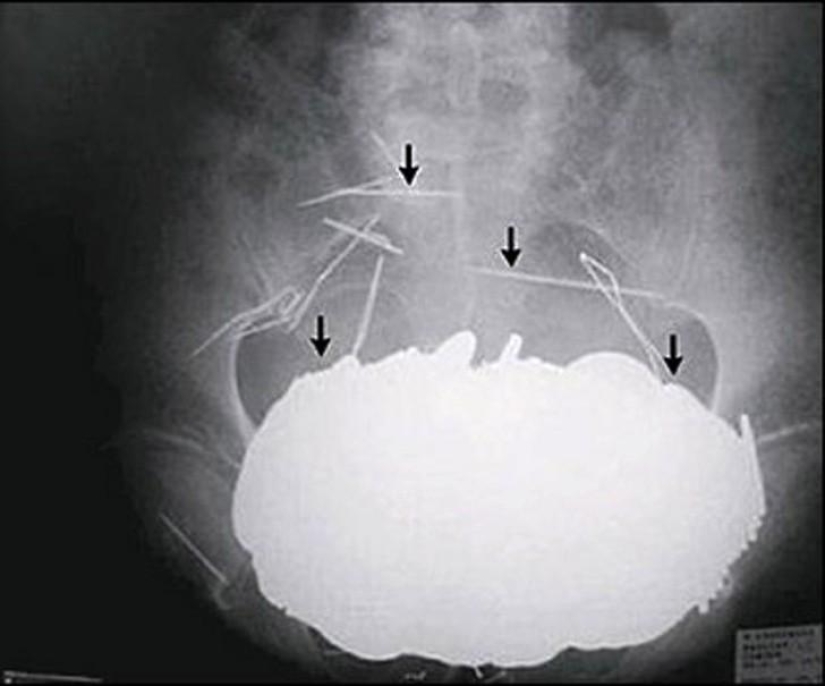 Los objetos más increíbles que se han encontrado en el cuerpo humano