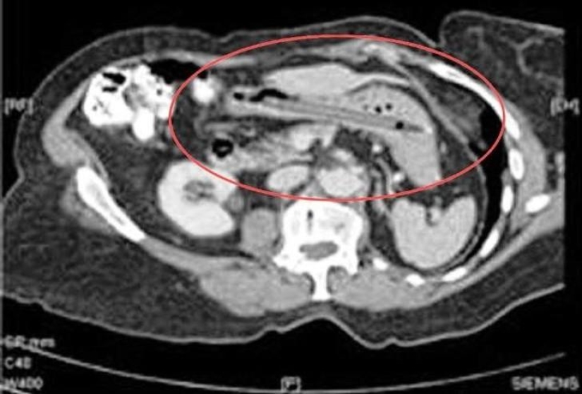 Los objetos más increíbles que se han encontrado en el cuerpo humano