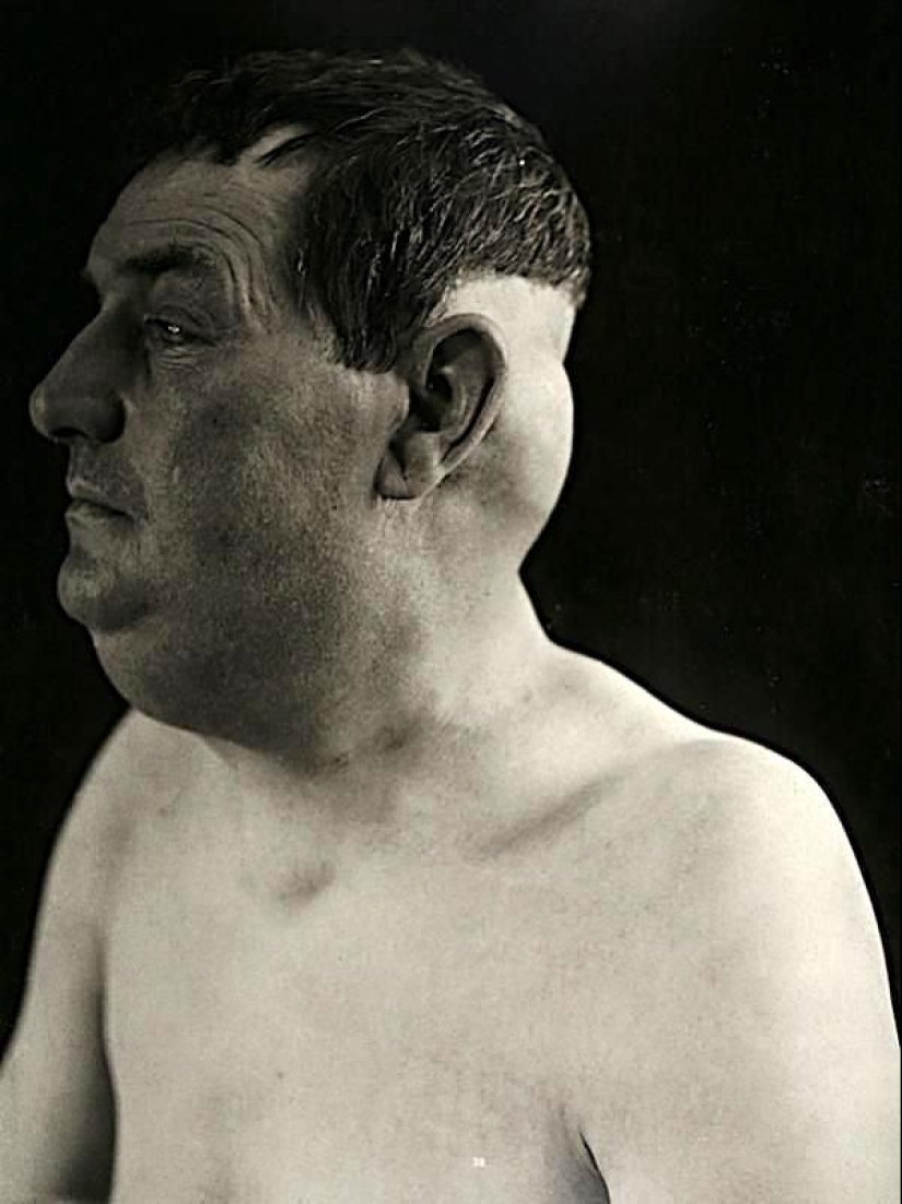 Portraits of pain: striking photographs of patients from nineteenth-century suffering from serious illnesses