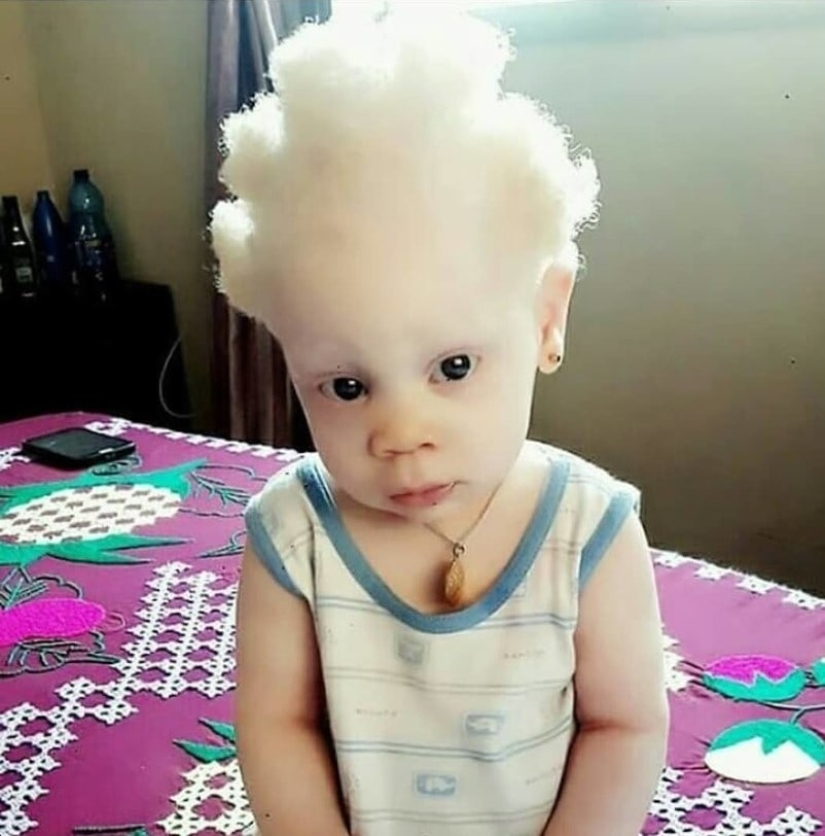 ¿Qué albinos de diferentes nacionalidades y razas parecen