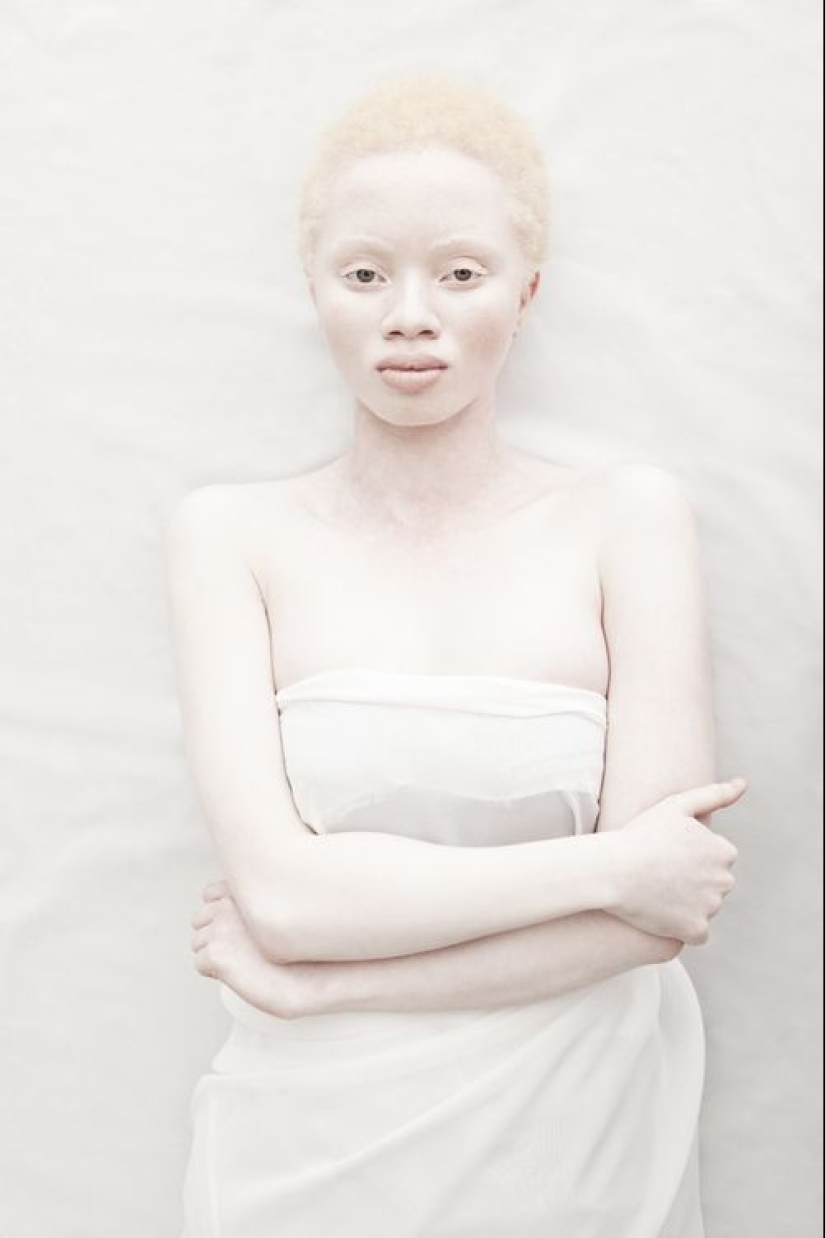 ¿Qué albinos de diferentes nacionalidades y razas parecen